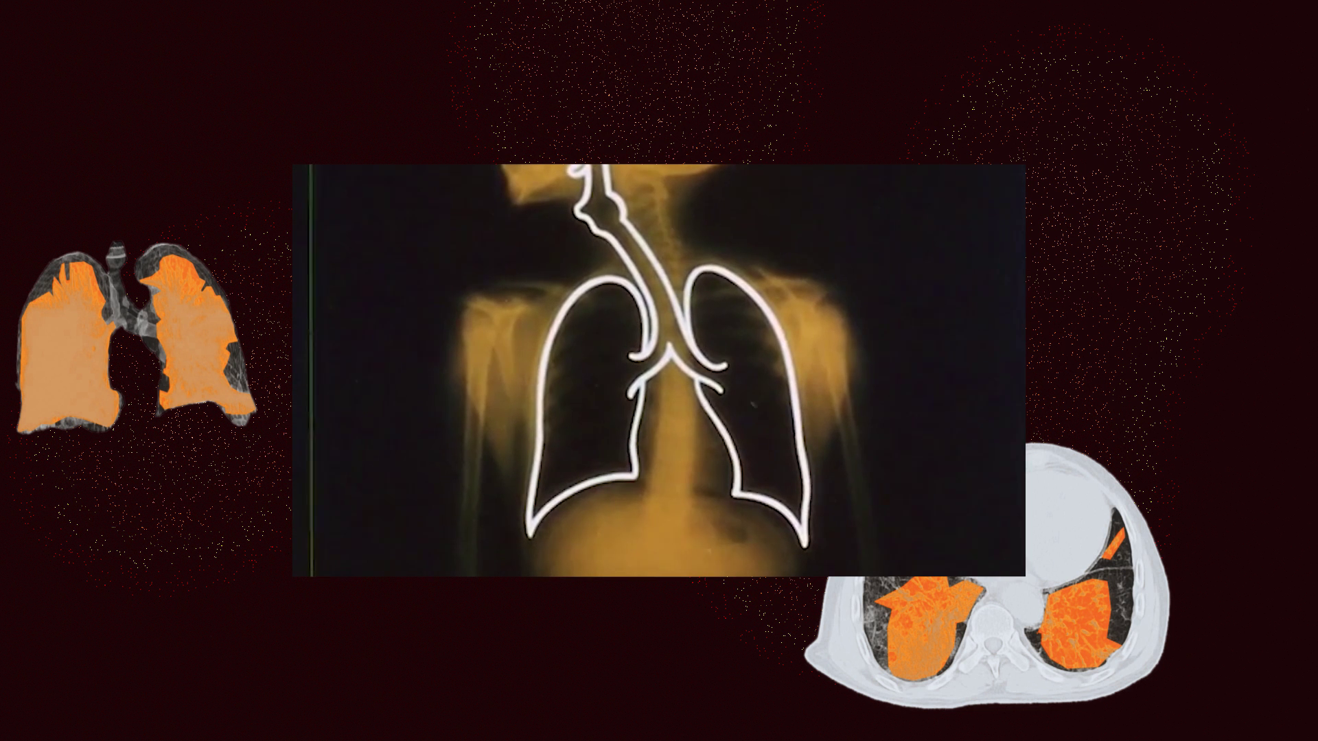 Membranes: Lungs and COVID-19 effects, illustrating human vulnerability